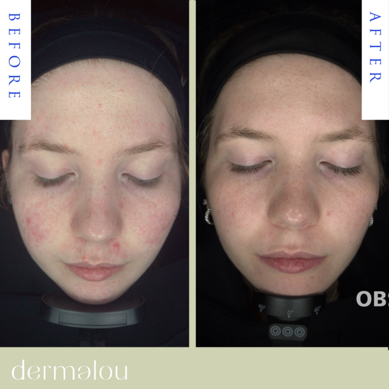 Template before after (3)