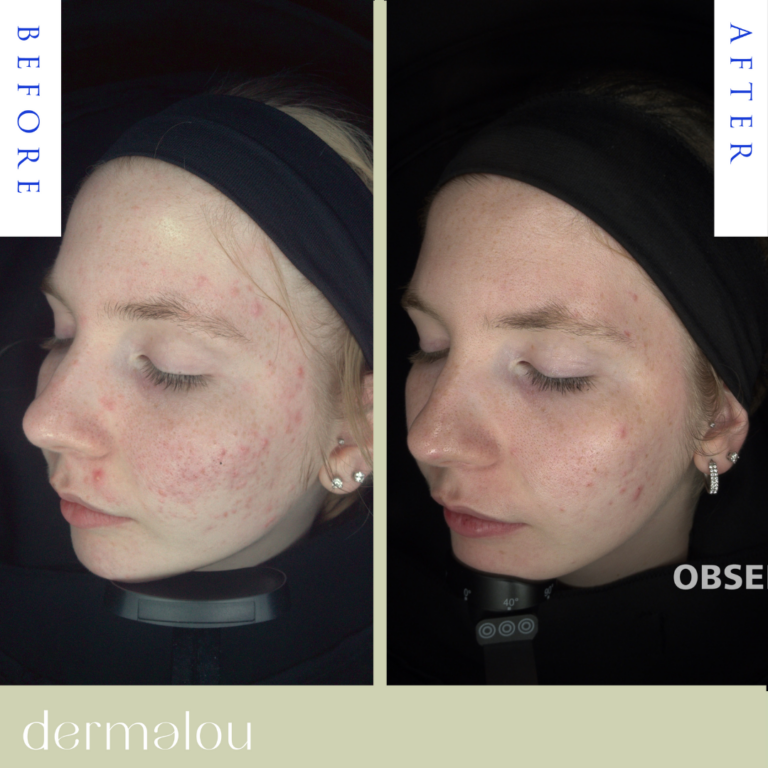 Template before after